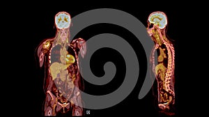 PET CT Scan fusion image It provides detailed images by merging