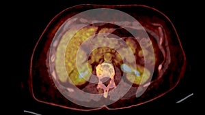 PET CT Scan fusion image It provides detailed images by merging