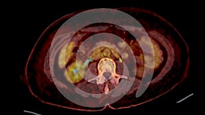 PET CT Scan fusion image It provides detailed images by merging