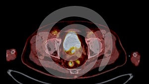 PET CT Scan fusion image It provides detailed images by merging