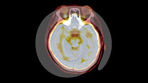 PET CT Scan fusion image It provides detailed images by merging