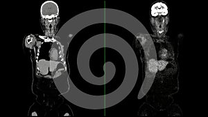 PET CT Scan fusion image It provides detailed images by merging