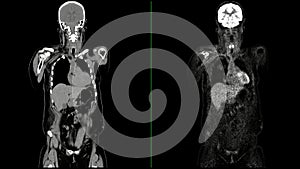 PET CT Scan fusion image It provides detailed images by merging