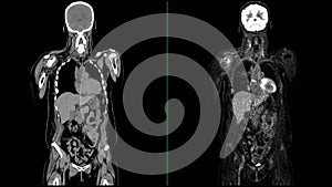 PET CT Scan fusion image It provides detailed images by merging