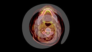 PET CT Scan fusion image It provides detailed images by merging