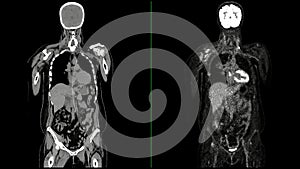 PET CT Scan fusion image It provides detailed images by merging