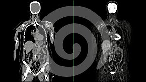 PET CT Scan fusion image It provides detailed images by merging