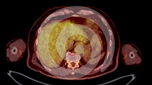 PET CT Scan fusion image It provides detailed images by merging