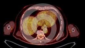 PET CT Scan fusion image It provides detailed images by merging