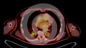 PET CT Scan fusion image It provides detailed images by merging