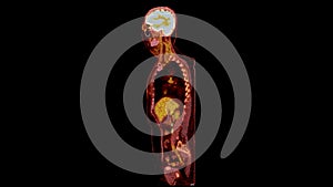 PET CT Scan fusion image It provides detailed images by merging