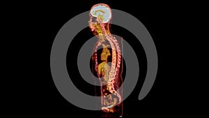 PET CT Scan fusion image It provides detailed images by merging