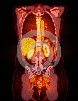 A PET-CT scan image is a diagnostic visualization combining Positron Emission Tomography.