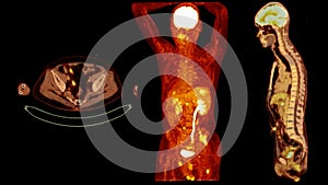 A PET-CT scan image