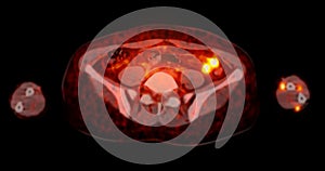A PET-CT scan image is a diagnostic visualization combining Positron Emission Tomography (PET).