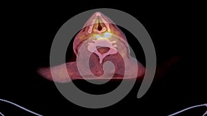 A PET-CT scan image is a diagnostic visualization combining Positron Emission Tomography (PET) and Computed Tomography .