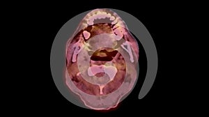 A PET-CT scan image is a diagnostic visualization combining Positron Emission Tomography (PET) and Computed Tomography .