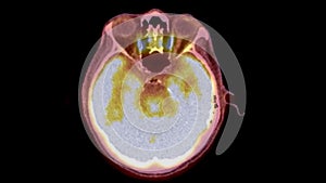 A PET-CT scan image is a diagnostic visualization combining Positron Emission Tomography (PET) and Computed Tomography .