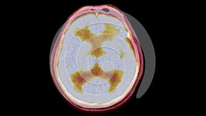 A PET-CT scan image is a diagnostic visualization combining Positron Emission Tomography (PET) and Computed Tomography .