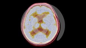 A PET-CT scan image is a diagnostic visualization combining Positron Emission Tomography (PET) and Computed Tomography .