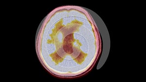 A PET-CT scan image is a diagnostic visualization combining Positron Emission Tomography (PET) and Computed Tomography .