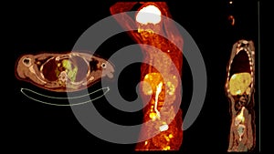 A PET-CT scan image is a diagnostic visualization combining Positron Emission Tomography (PET) and Computed Tomography .