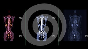 A PET-CT scan image is a diagnostic visualization combining Positron Emission Tomography (PET) and Computed Tomography .