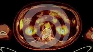 A PET-CT scan image is a diagnostic visualization combining Positron Emission Tomography (PET) and Computed Tomography .