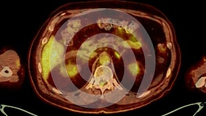 A PET-CT scan image is a diagnostic visualization combining Positron Emission Tomography (PET) and Computed Tomography .