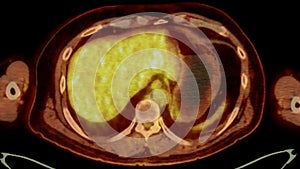 A PET-CT scan image is a diagnostic visualization combining Positron Emission Tomography (PET) and Computed Tomography .