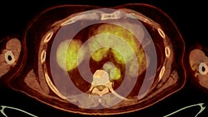 A PET-CT scan image is a diagnostic visualization combining Positron Emission Tomography (PET) and Computed Tomography .