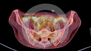 A PET-CT scan image is a diagnostic visualization combining Positron Emission Tomography (PET) and Computed Tomography .
