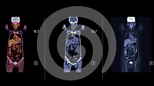 A PET-CT scan image is a diagnostic visualization combining Positron Emission Tomography (PET) and Computed Tomography .