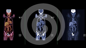 A PET-CT scan image is a diagnostic visualization combining Positron Emission Tomography (PET) and Computed Tomography .