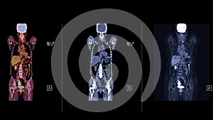 A PET-CT scan image is a diagnostic visualization combining Positron Emission Tomography (PET) and Computed Tomography .