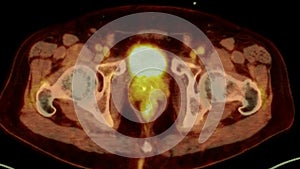 A PET-CT scan image is a diagnostic visualization combining Positron Emission Tomography (PET) and Computed Tomography .