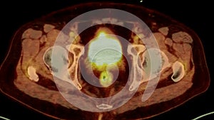 A PET-CT scan image is a diagnostic visualization combining Positron Emission Tomography (PET) and Computed Tomography .