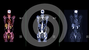 A PET-CT scan image is a diagnostic visualization combining Positron Emission Tomography (PET) and Computed Tomography .