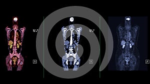 A PET-CT scan image is a diagnostic visualization combining Positron Emission Tomography (PET) and Computed Tomography .