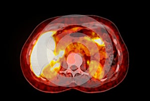 A PET-CT scan image is a diagnostic visualization combining Positron Emission Tomography (PET) and Computed Tomography
