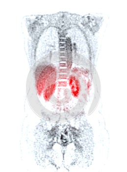 A PET-CT scan image is a diagnostic visualization combining Positron Emission Tomography (PET) and Computed Tomography