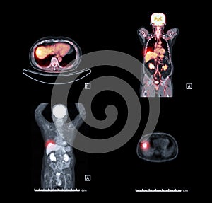 PET CT Scan image of whole body .