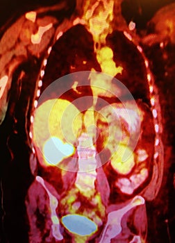 Pet ct scan liver mass oncological pathology