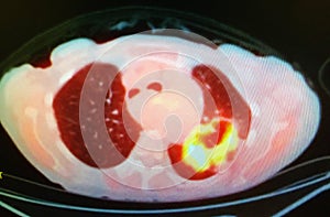 Pet ct scan lung cavitary mass malignancy photo