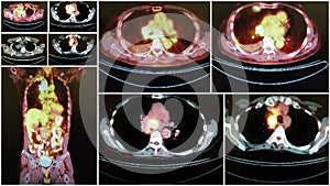 Pet ct tumor mediastinum and lung collage