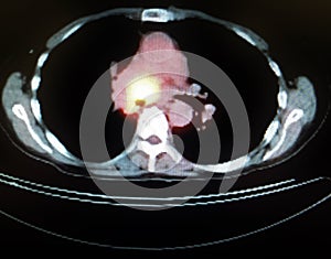 Pet ct tumor mediastinum penetrating lung frame