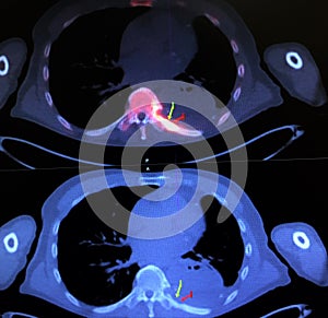 Pet ct vertebral body metastasis nuclear medicine