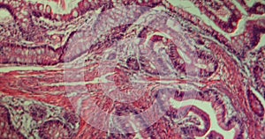 Peuz-JÃ¤ger polyp growth