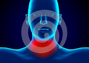 Pharyngitis is an infection of the pharynx caused by bacteria of the genus Streptococcus