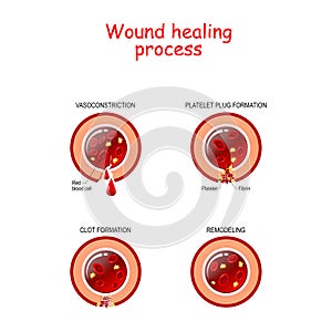 Phases of the wound healing process. poster with capillary, red blood cells, fibrin protein and platelets that healing wound